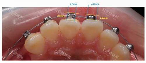 牙齿矫正OBrace球面托槽对比方形托槽大小