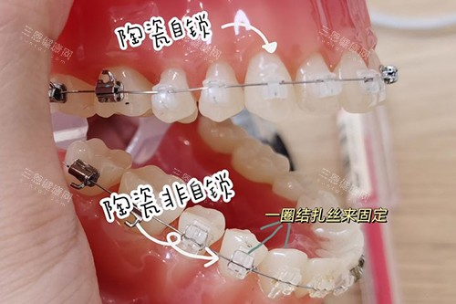 德宏牙齿矫正要花多少钱？良心牙科推荐！担心价格贵？这份省钱指南请收好！