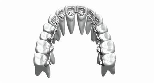 牙齿矫正舌侧矫正牙套概念透视图