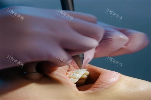 牙齿矫正操作中