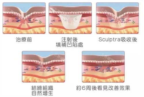 注射童颜针后皮肤的变化周期