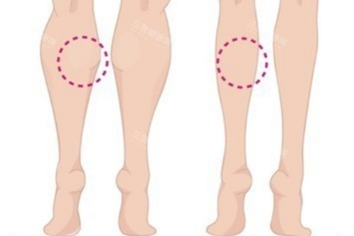 小腿肌肉消除卡通对比图