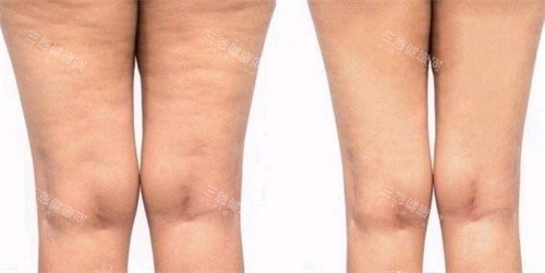 腿部吸脂手术前后对比图