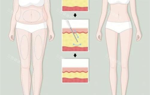 大腿环吸前后对比卡通示意图