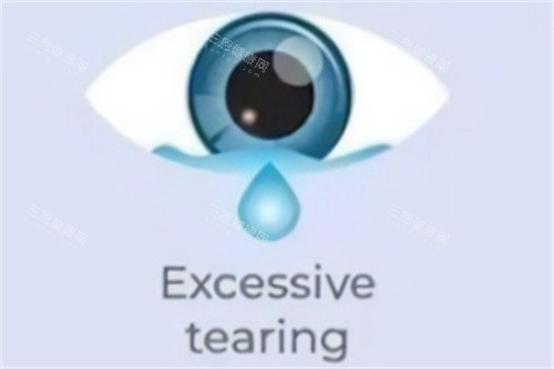 眼睛多泪示意图 眼睛多泪示意图