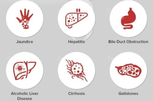 眼睛发黄原因 眼睛发黄原因