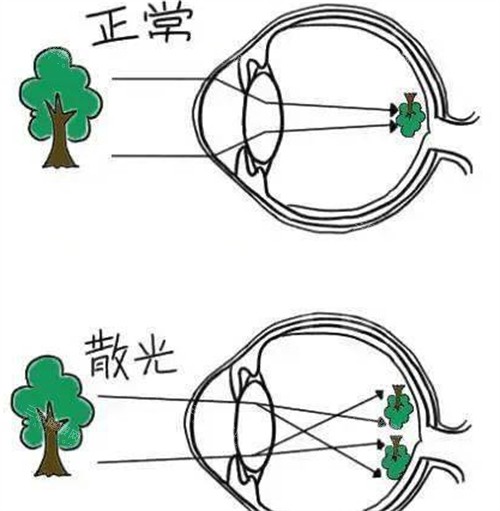 正常眼睛和散光眼睛呈现不同