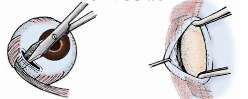 斜视下斜肌手术