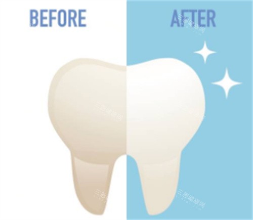 牙齿美白对比 牙齿美白对比