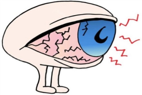 干眼症卡通图 干眼症卡通图