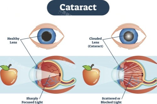 正常眼睛与白内障眼睛视物对比图 正常眼睛与白内障眼睛视物对比图