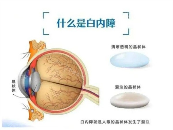 什么是白内障 什么是白内障