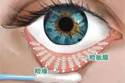 眼睛睑缘和睑板腺漫画图 眼睛睑缘和睑板腺漫画图