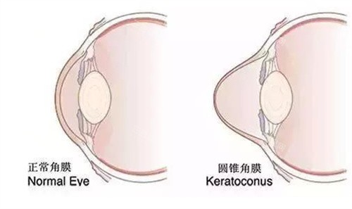 圆锥角膜示意图