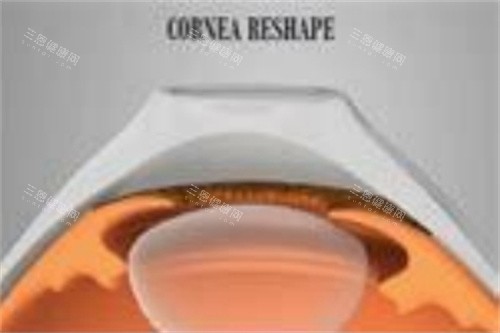 角膜塑形镜3副本