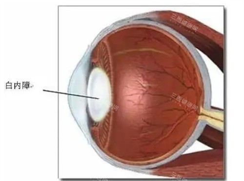 治疗白内障 治疗白内障
