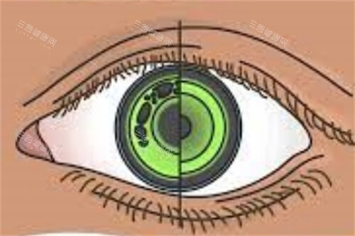 佩戴角膜塑形镜眼睛示意图