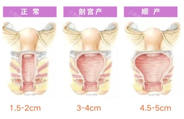 打紧缩针5个月真实反馈：从犹豫到松弛，我的私密紧致经历全坦白！