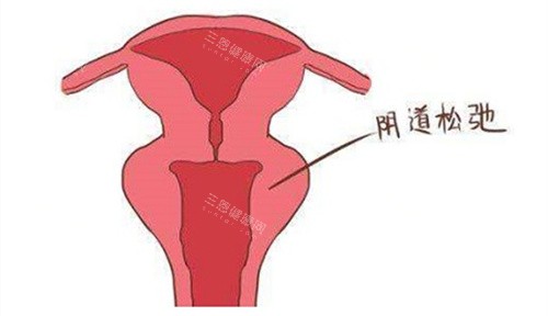 阴道松弛动画演示图 阴道松弛动画演示图