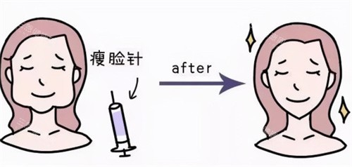 瘦脸注射前后卡通