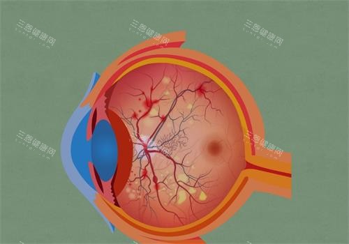 视网膜色素变性的眼睛