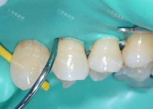 橡皮障在补牙中的运用