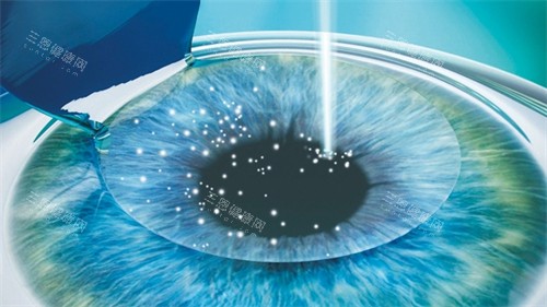 个性化飞秒手术中 个性化飞秒手术中
