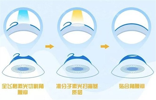 飞秒激光手术过程