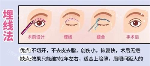 双眼皮手术埋线法动画演示图