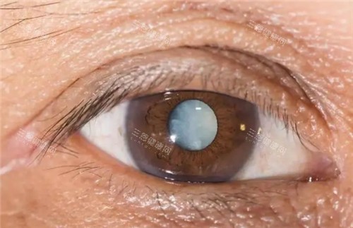 白内障免费治疗政策到哪里申请？70岁白内障手术免费政策全解析