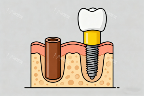 单颗种植牙卡通图展示 单颗种植牙卡通图展示