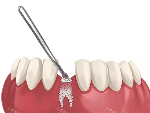 韩国DIO种植牙靠谱吗？与登腾/奥齿泰对比，谁的性价比更高？