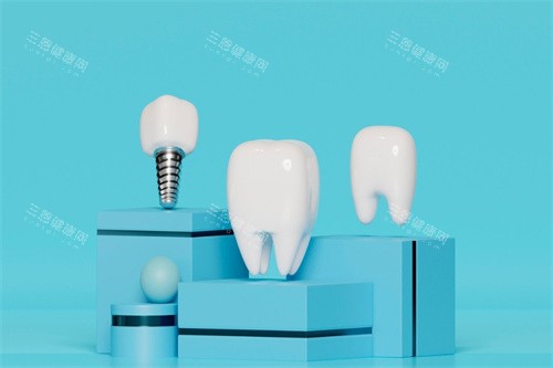 种植牙牙冠展示 种植牙牙冠展示