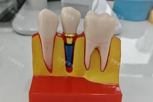 种植牙模型实拍 种植牙模型实拍