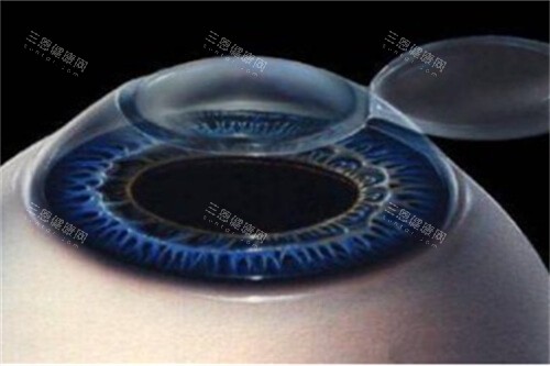 近视眼手术1 近视眼手术1