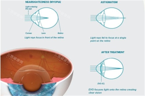ICL晶体原理解析