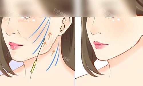 拉皮手术成效示意图