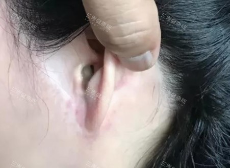 拉皮手术疤痕图