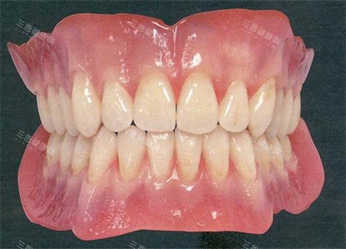 活动假牙全口示意图
