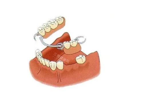 7活动假牙佩戴模型图