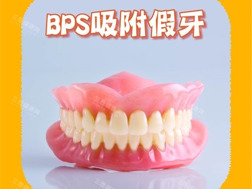 BPS吸附性义齿模型图 BPS吸附性义齿模型图