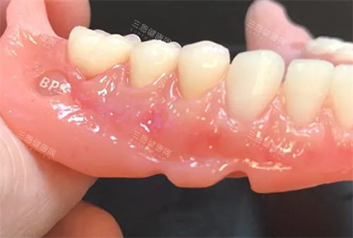 BPS吸附性义齿成品 BPS吸附性义齿成品