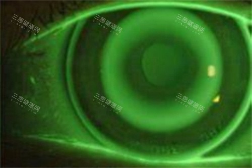 角膜塑形镜32 角膜塑形镜32