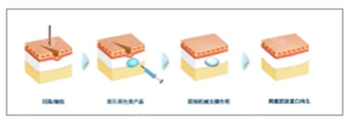 童颜针注射前后对比图解