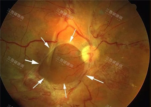 视网膜脱落细节表现图