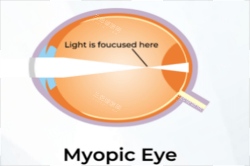 近视示意图 近视示意图