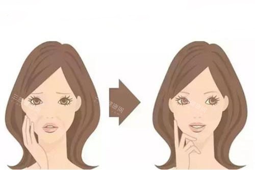 面部注射卡通对比图 面部注射卡通对比图