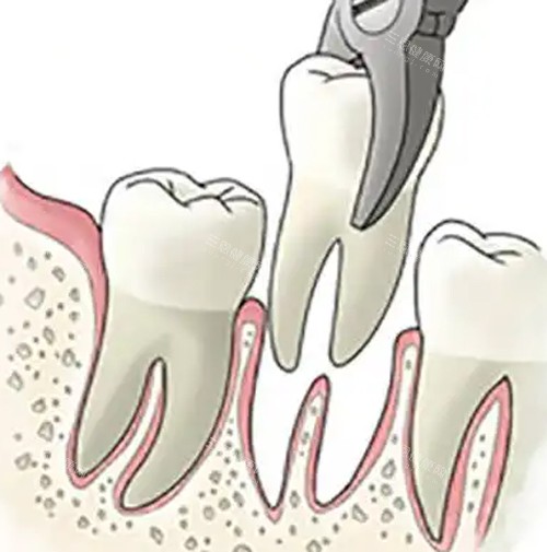 乌鲁木齐拔牙价格全透明：普通牙150/智齿400起/复杂情况1500，附医生选择建议！