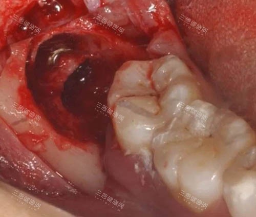 拔牙手术细节图 拔牙手术细节图