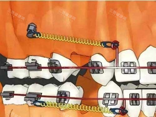 拔牙矫正骨钉种植钉 拔牙矫正骨钉种植钉